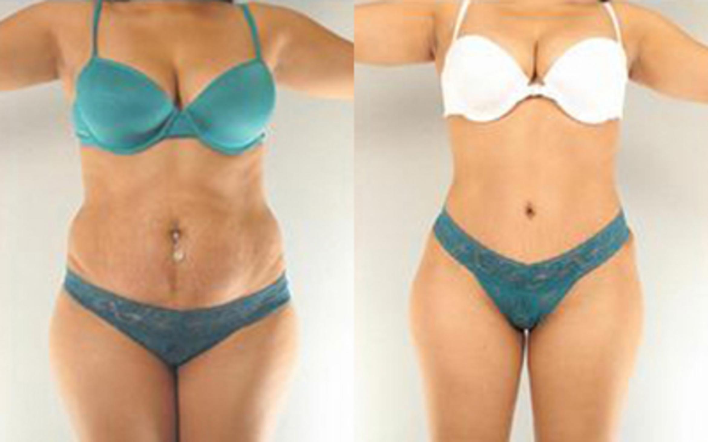 Before & After Tummy Tuck Case 1 View 1 View in Houston, TX