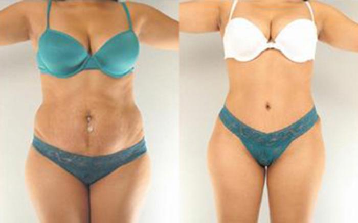Before & After Tummy Tuck Case 1 View 1 View in Houston, TX
