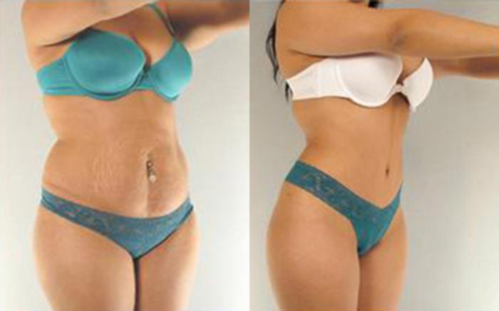 Before & After Tummy Tuck Case 1 View 2 View in Houston, TX