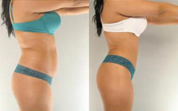 Before & After Tummy Tuck Case 1 View 3 View in Houston, TX