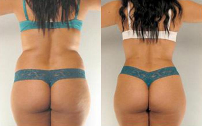 Before & After Tummy Tuck Case 1 View 4 View in Houston, TX