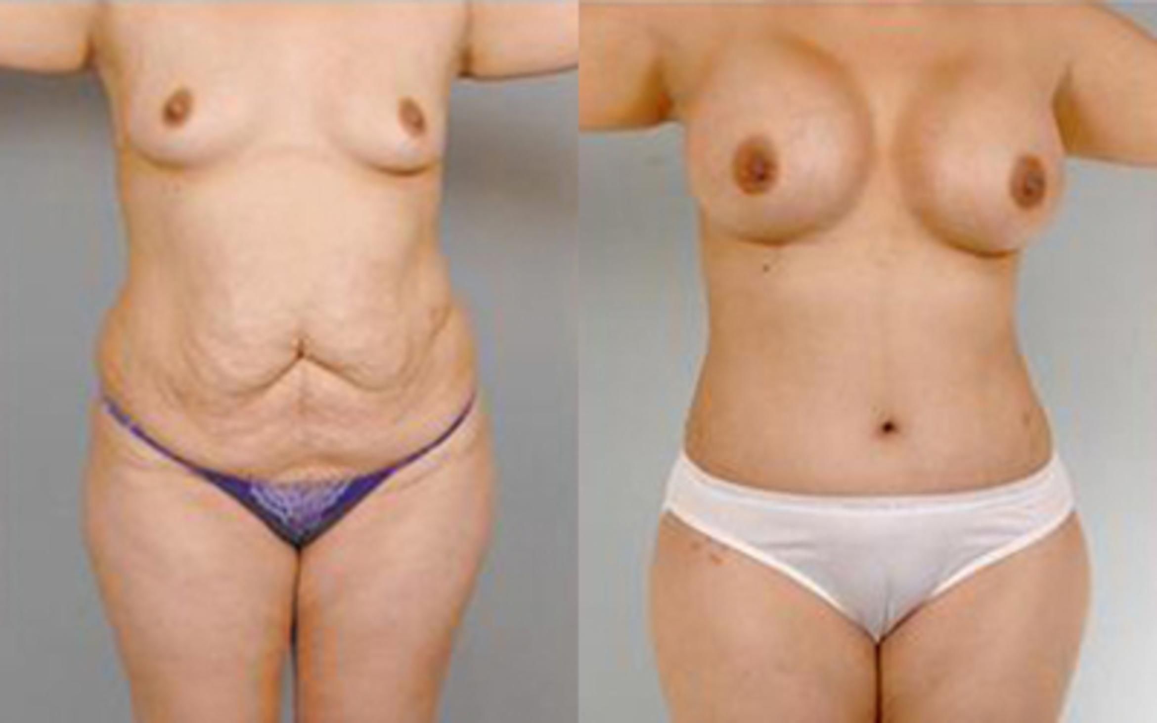 Before & After Tummy Tuck Case 10 View 1 View in Houston, TX