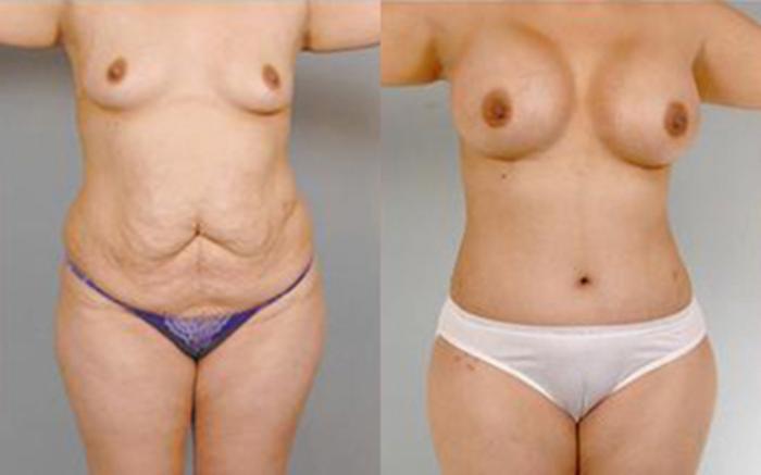 Before & After Tummy Tuck Case 10 View 1 View in Houston, TX