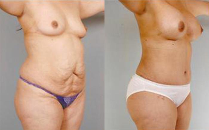 Before & After Tummy Tuck Case 10 View 2 View in Houston, TX