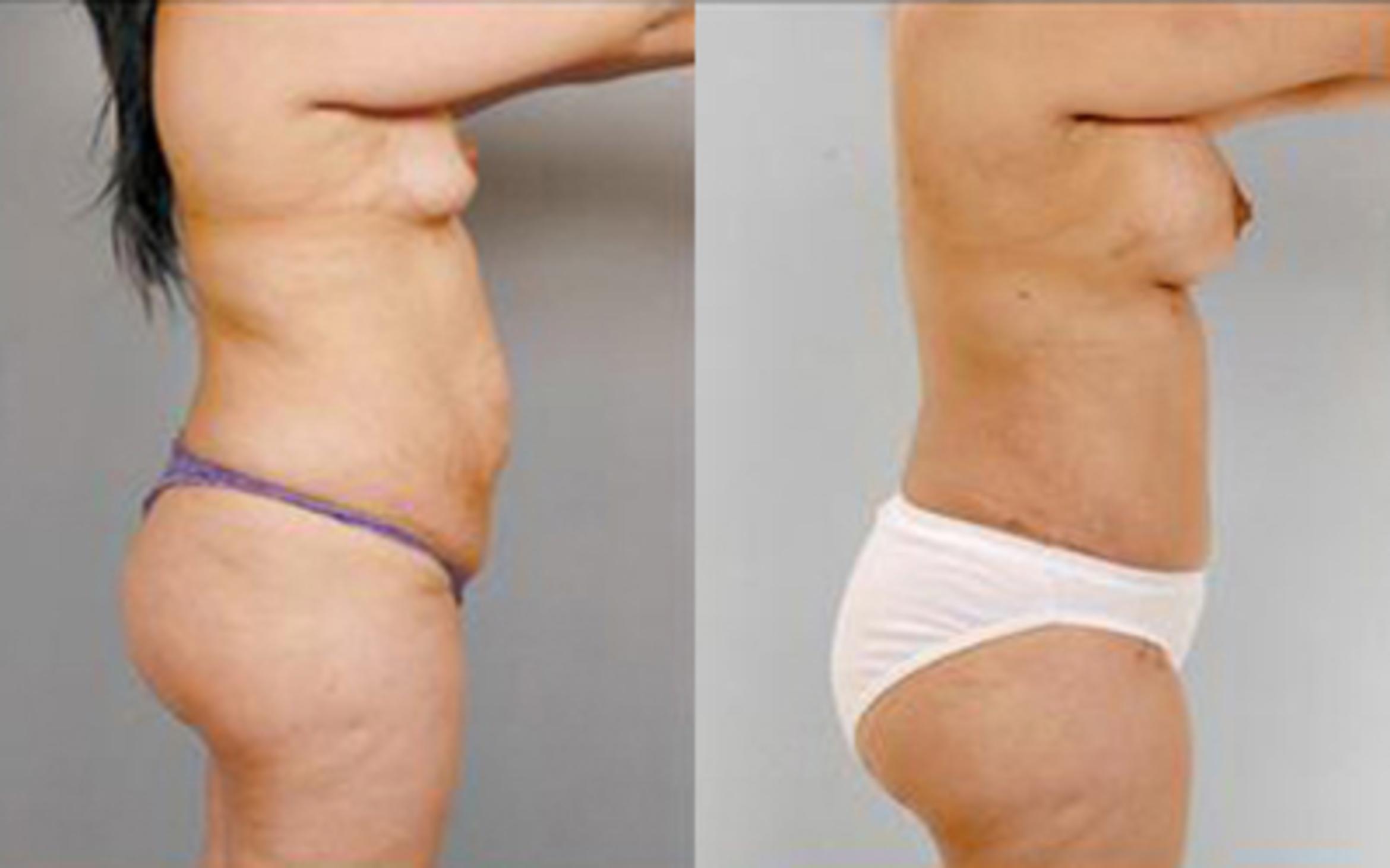 Before & After Tummy Tuck Case 10 View 3 View in Houston, TX