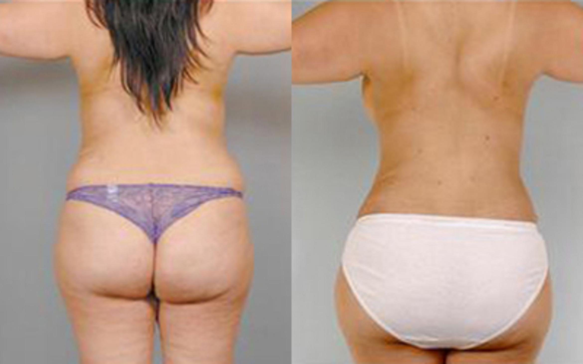 Before & After Tummy Tuck Case 10 View 4 View in Houston, TX
