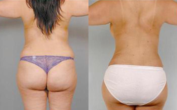 Before & After Tummy Tuck Case 10 View 4 View in Houston, TX