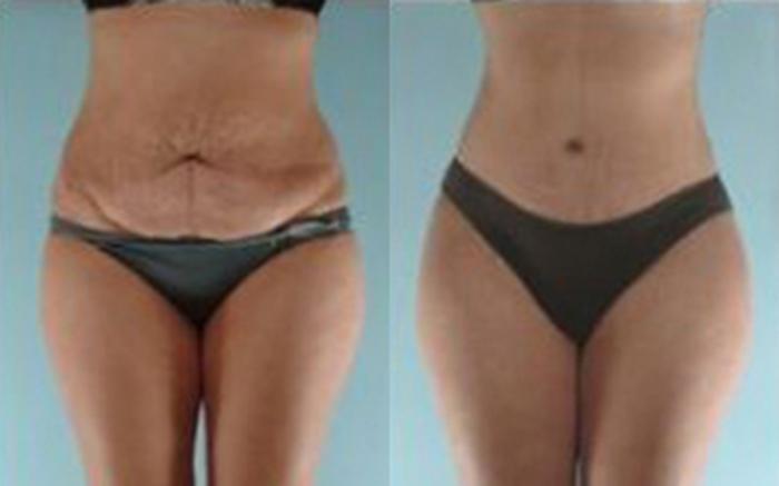 Before & After Tummy Tuck Case 11 View 1 View in Houston, TX