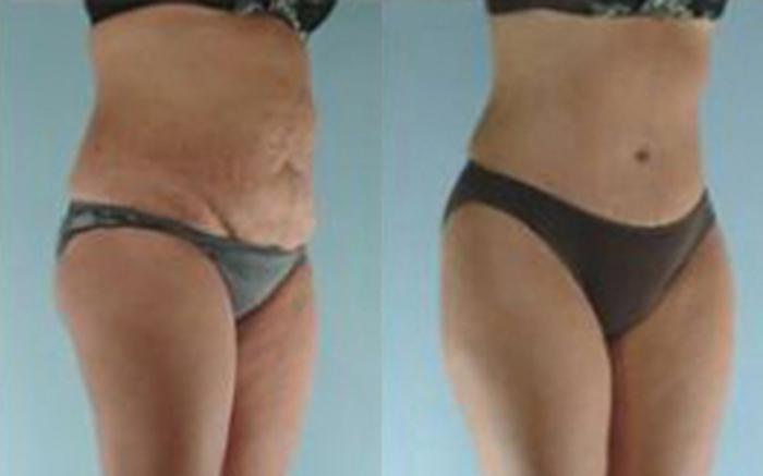 Before & After Tummy Tuck Case 11 View 2 View in Houston, TX