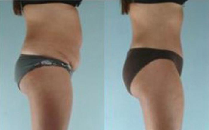 Before & After Tummy Tuck Case 11 View 3 View in Houston, TX