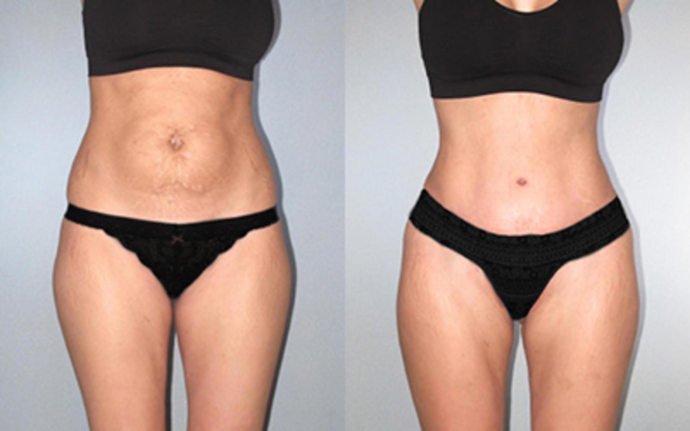 Before & After Tummy Tuck Case 118534 View 1 View in Houston, TX