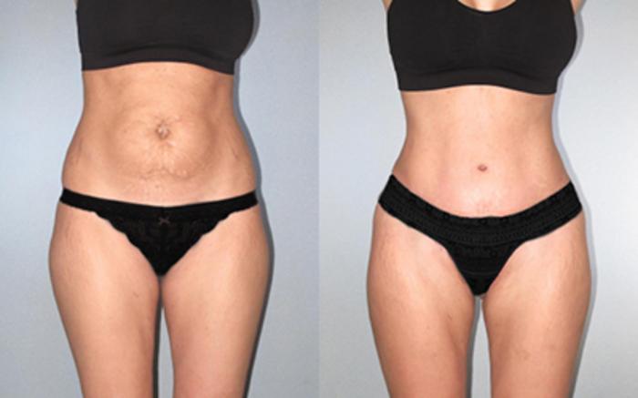 Before & After Tummy Tuck Case 118534 View 1 View in Houston, TX