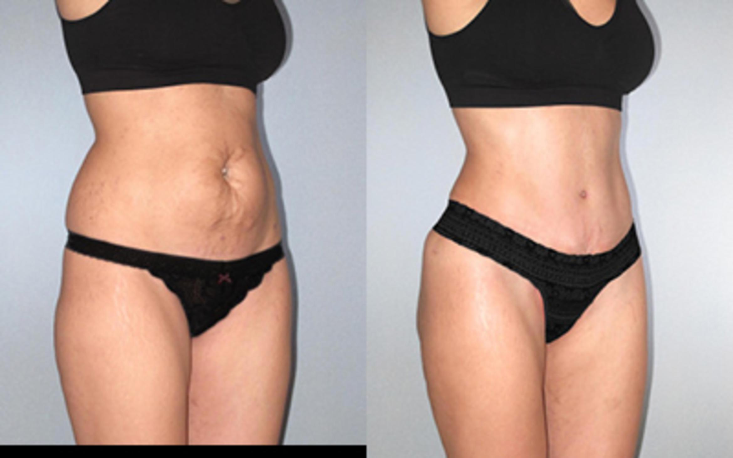 Before & After Tummy Tuck Case 118534 View 2 View in Houston, TX