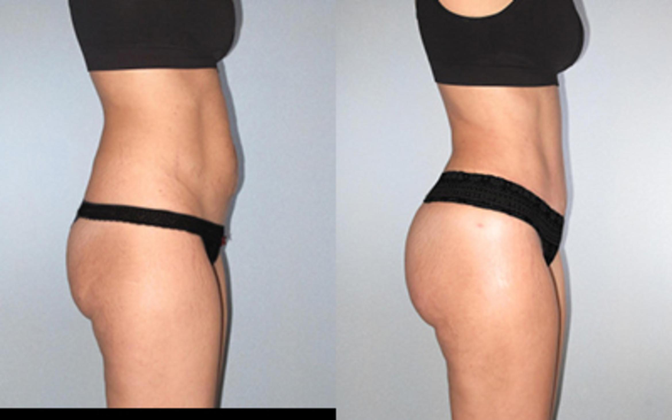 Before & After Tummy Tuck Case 118534 View 3 View in Houston, TX