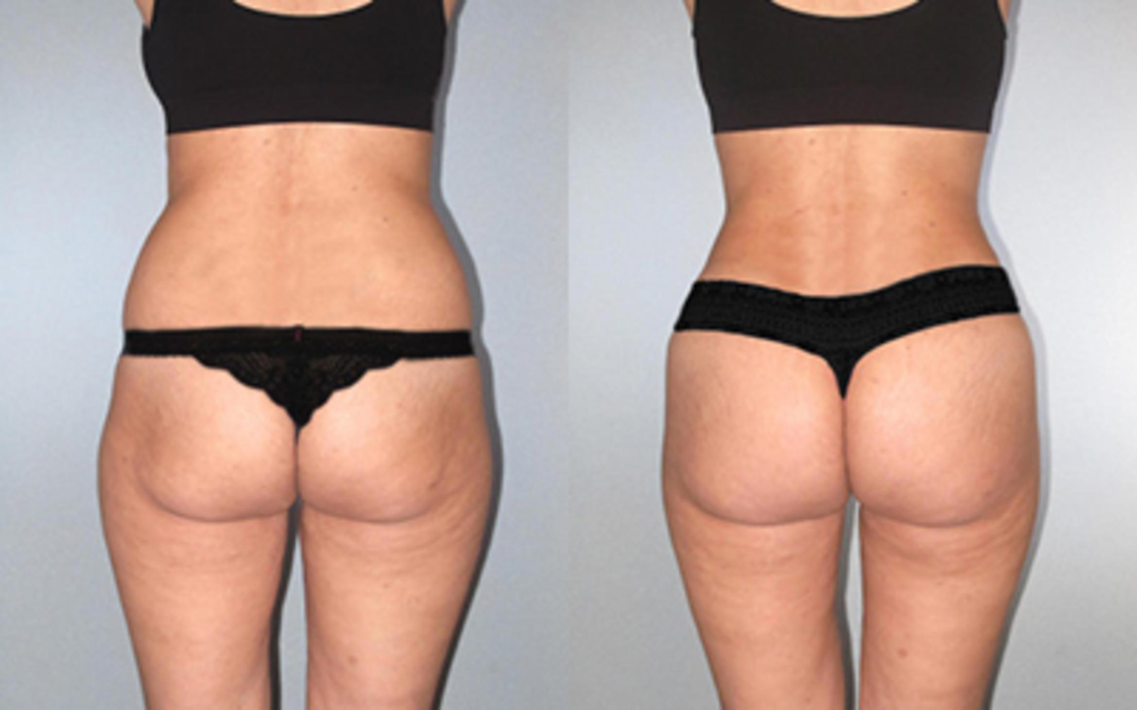 Before & After Tummy Tuck Case 118534 View 4 View in Houston, TX