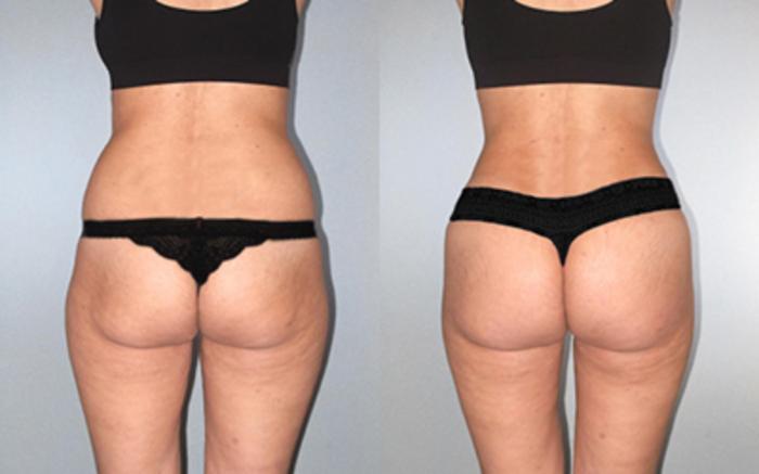 Before & After Tummy Tuck Case 118534 View 4 View in Houston, TX