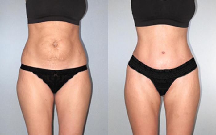 Before & After Tummy Tuck Case 1185349999 View 1 View in Houston, TX