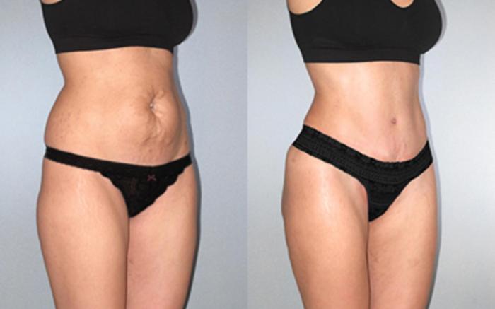 Before & After Tummy Tuck Case 1185349999 View 2 View in Houston, TX
