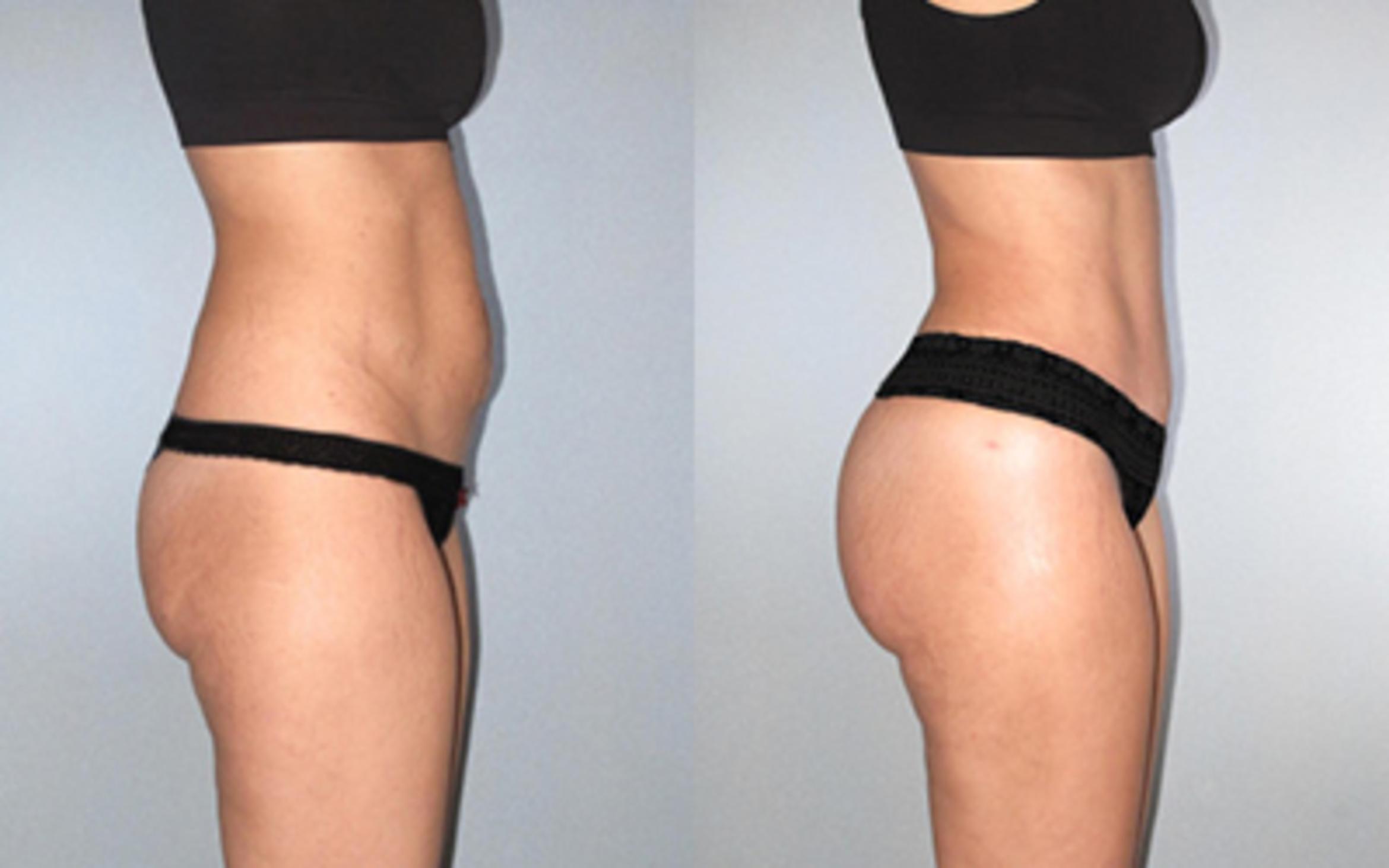 Before & After Tummy Tuck Case 1185349999 View 3 View in Houston, TX