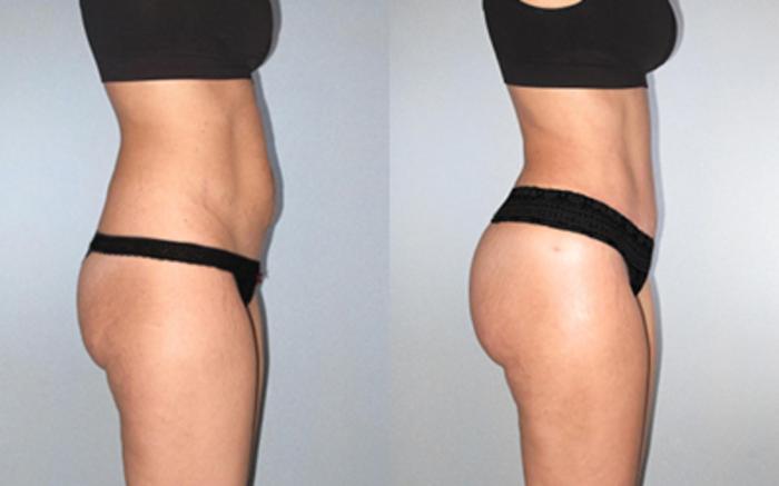 Before & After Tummy Tuck Case 1185349999 View 3 View in Houston, TX