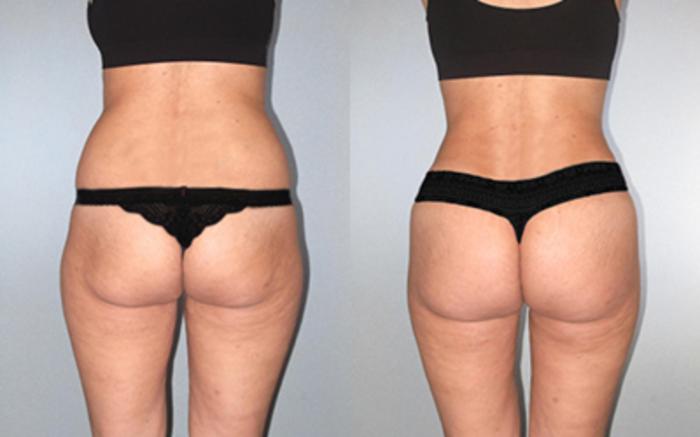 Before & After Tummy Tuck Case 1185349999 View 4 View in Houston, TX