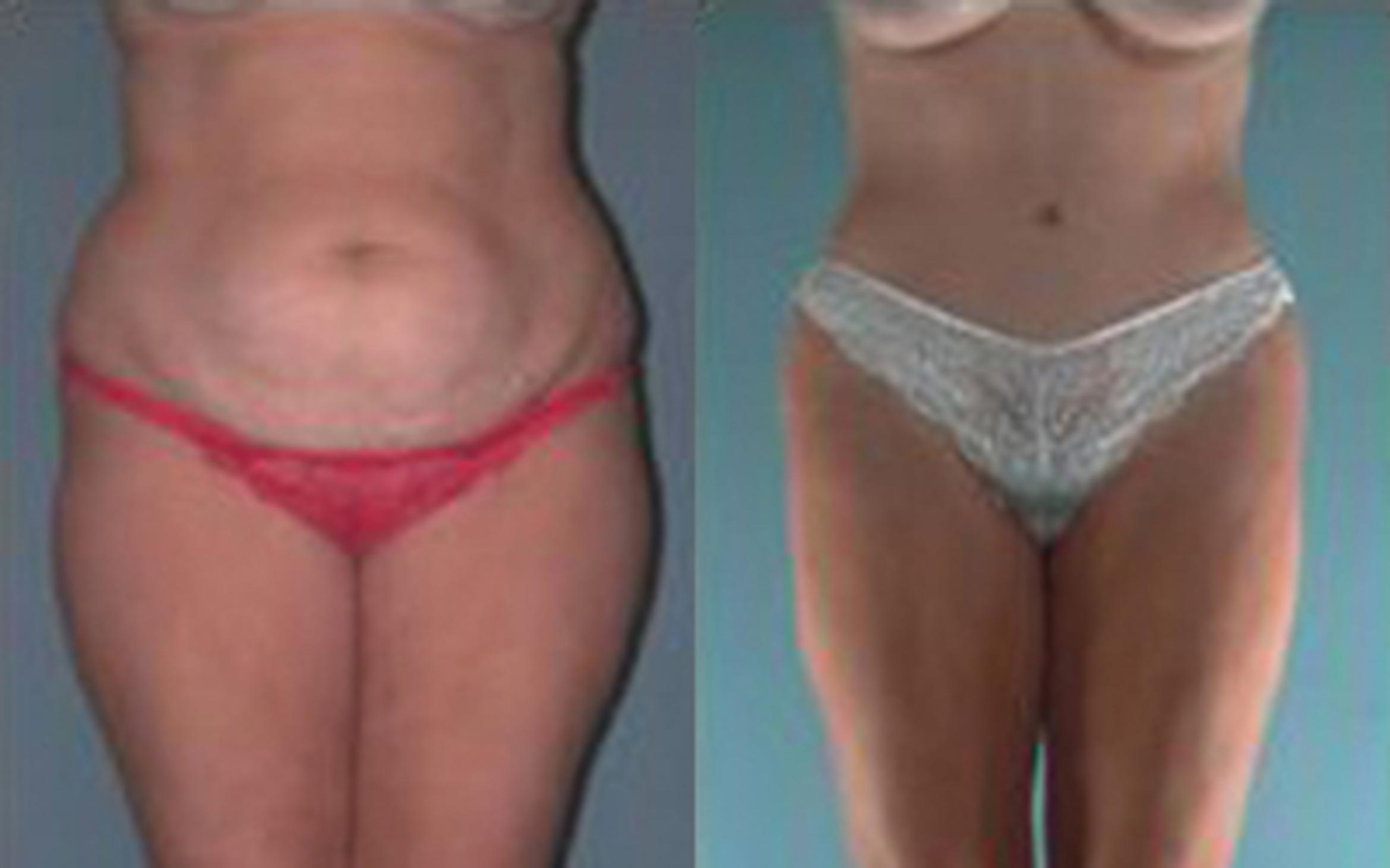Before & After Tummy Tuck Case 12 View 1 View in Houston, TX