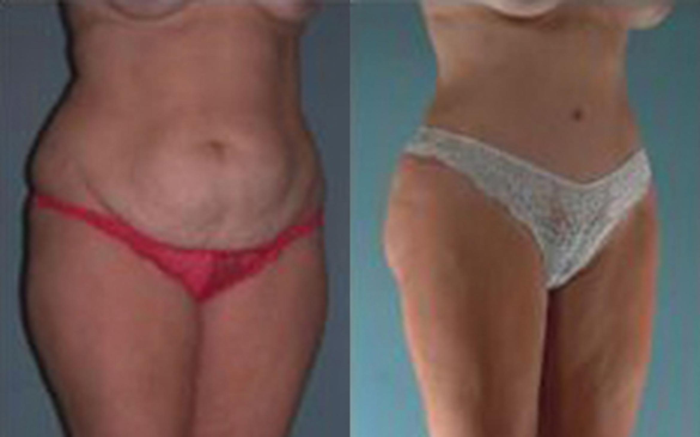 Before & After Tummy Tuck Case 12 View 2 View in Houston, TX