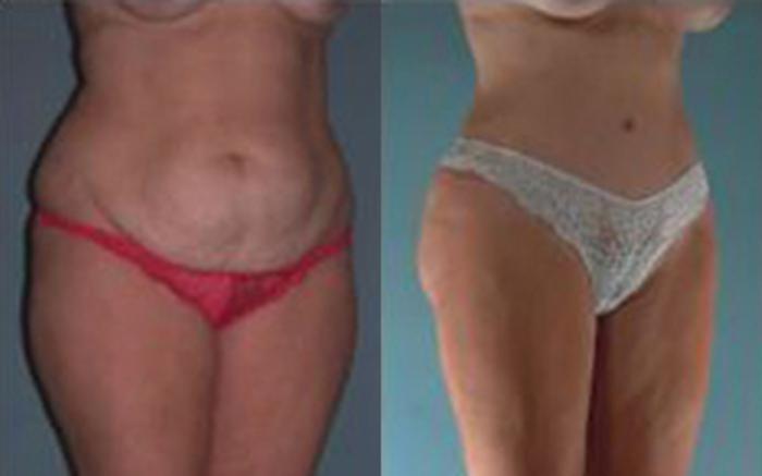 Before & After Tummy Tuck Case 12 View 2 View in Houston, TX