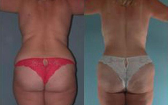 Before & After Tummy Tuck Case 12 View 3 View in Houston, TX