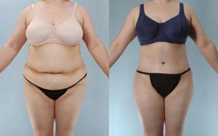 Before & After Tummy Tuck Case 13 View 1 View in Houston, TX