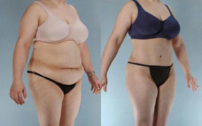 Before & After Tummy Tuck Case 13 View 2 View in Houston, TX