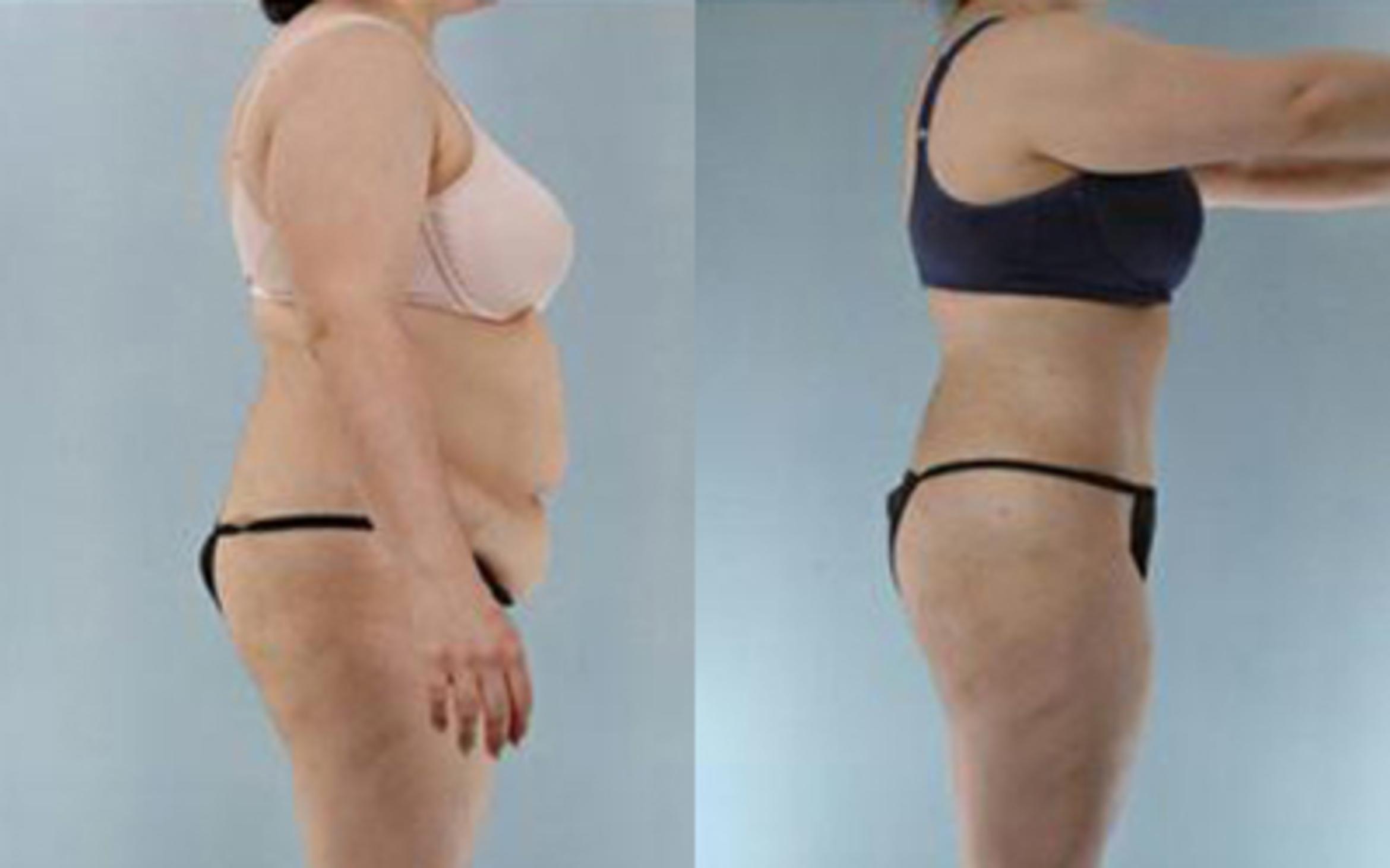 Before & After Tummy Tuck Case 13 View 3 View in Houston, TX