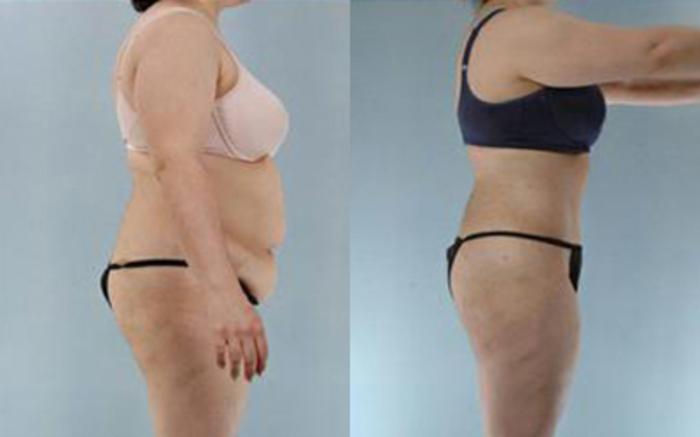 Before & After Tummy Tuck Case 13 View 3 View in Houston, TX