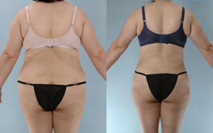 Before & After Tummy Tuck Case 13 View 4 View in Houston, TX