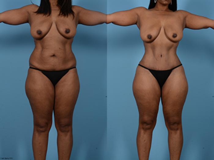 Before & After Tummy Tuck Case 132484 View 1 View in Houston, TX