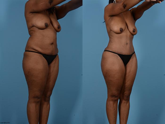 Before & After Tummy Tuck Case 132484 View 2 View in Houston, TX