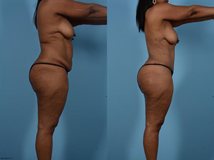 Before & After Tummy Tuck Case 132484 View 3 View in Houston, TX