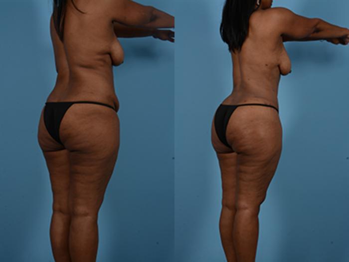 Before & After Tummy Tuck Case 132484 View 4 View in Houston, TX