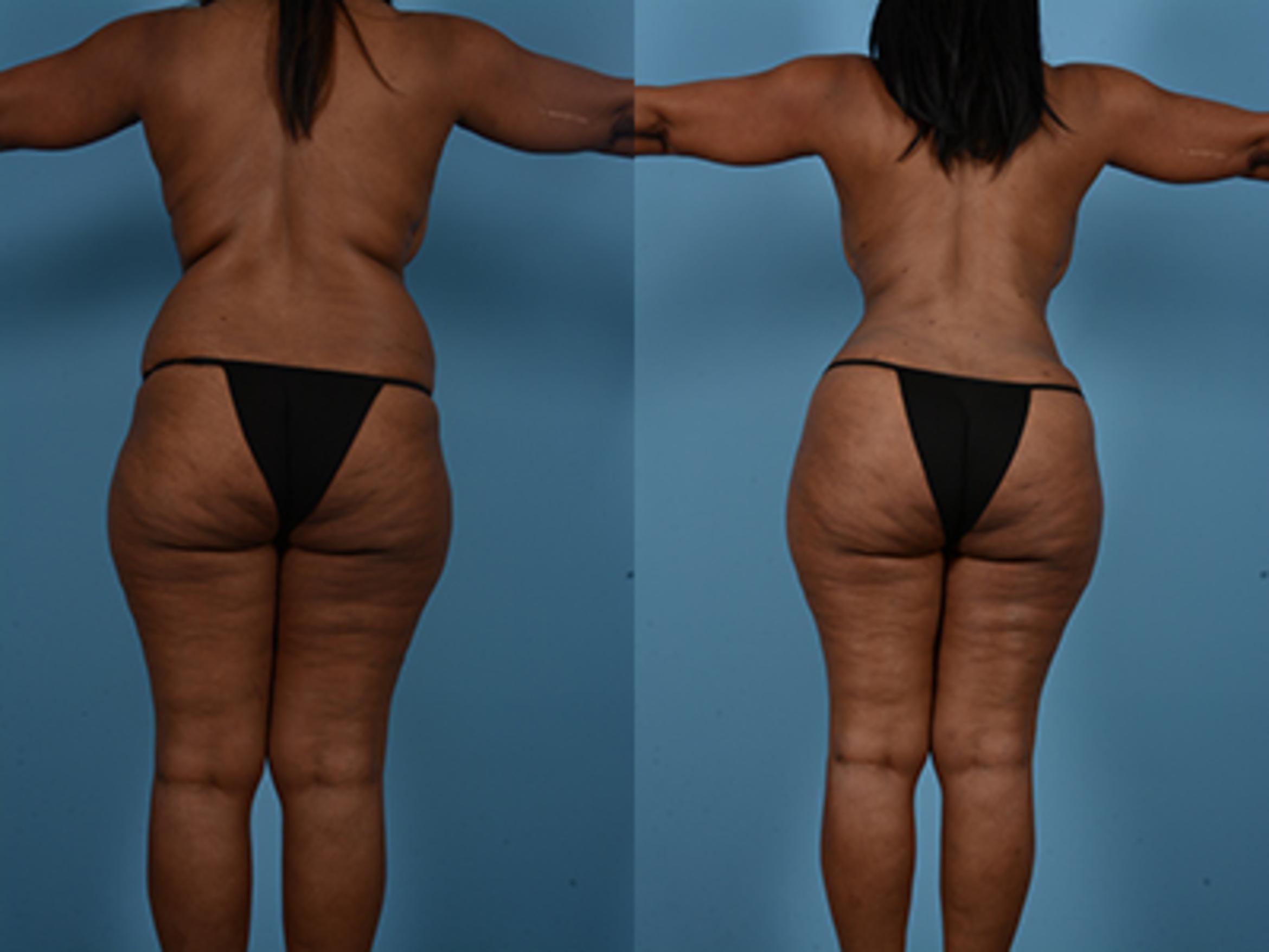Before & After Tummy Tuck Case 132484 View 5 View in Houston, TX
