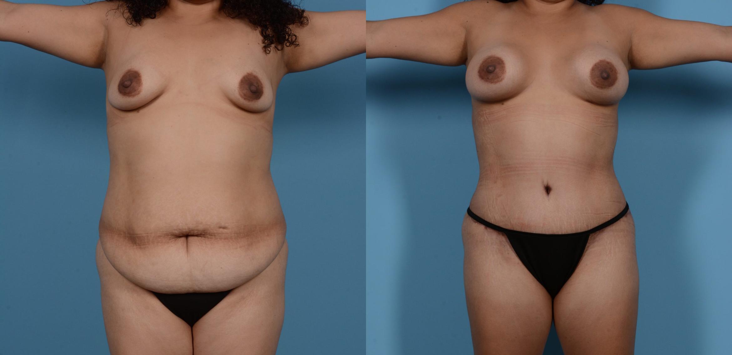 Before & After Tummy Tuck Case 137201 View 1 View in Houston, TX