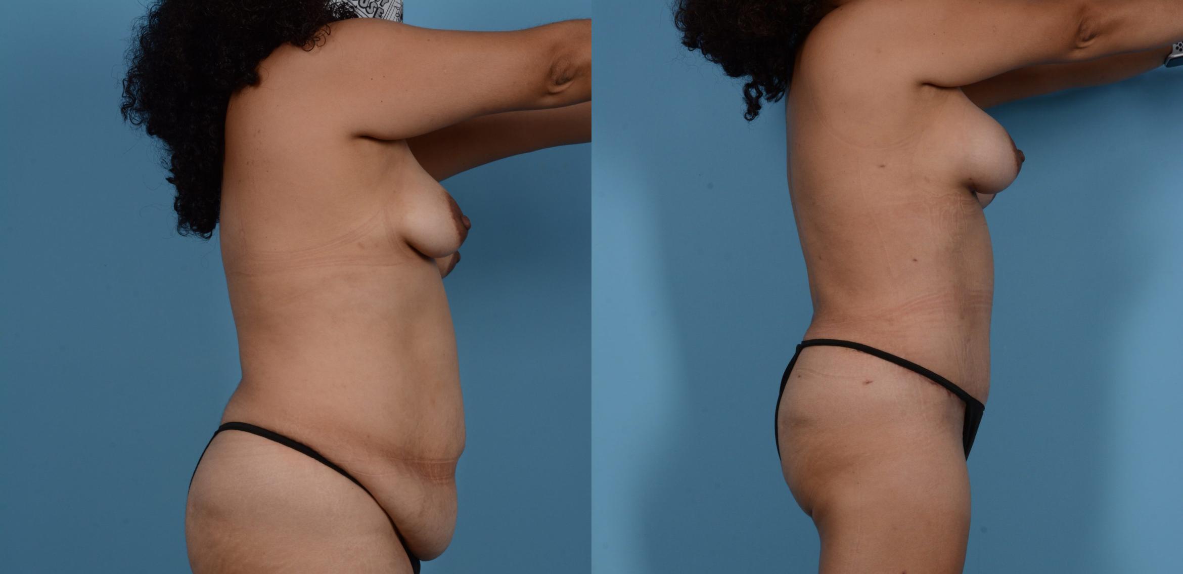 Before & After Tummy Tuck Case 137201 View 3 View in Houston, TX