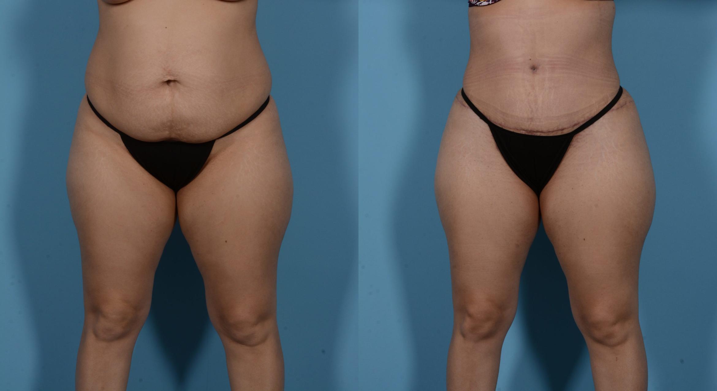 Before & After Tummy Tuck Case 138173 View 1 View in Houston, TX