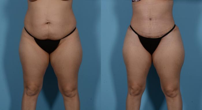 Before & After Tummy Tuck Case 138173 View 1 View in Houston, TX