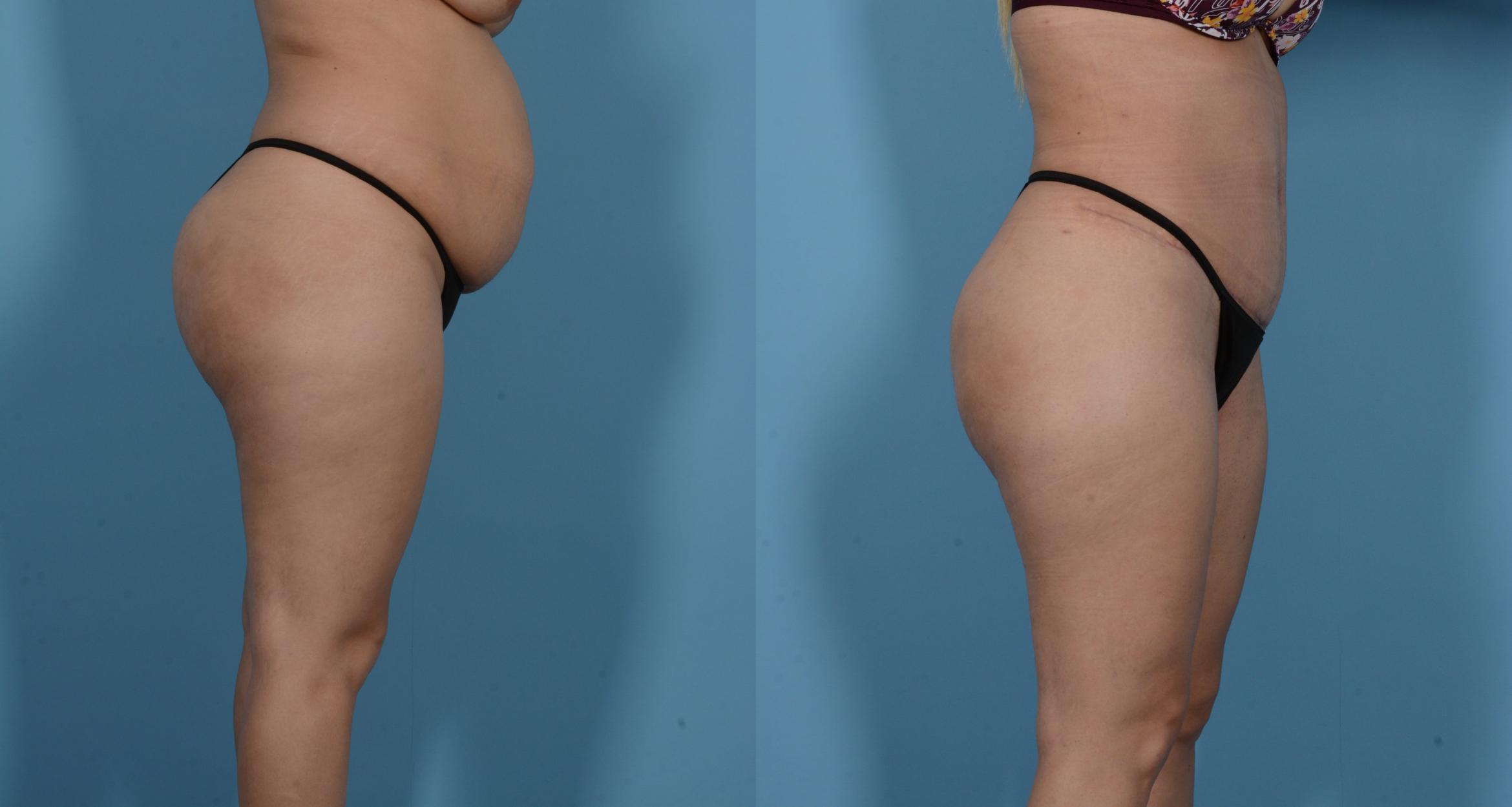Before & After Tummy Tuck Case 138173 View 2 View in Houston, TX