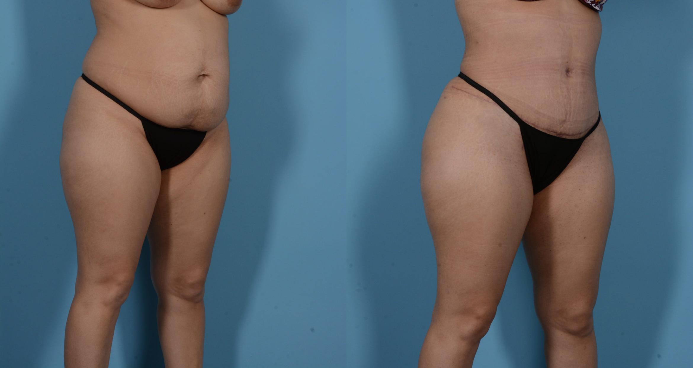 Before & After Tummy Tuck Case 138173 View 3 View in Houston, TX