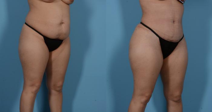 Before & After Tummy Tuck Case 138173 View 3 View in Houston, TX