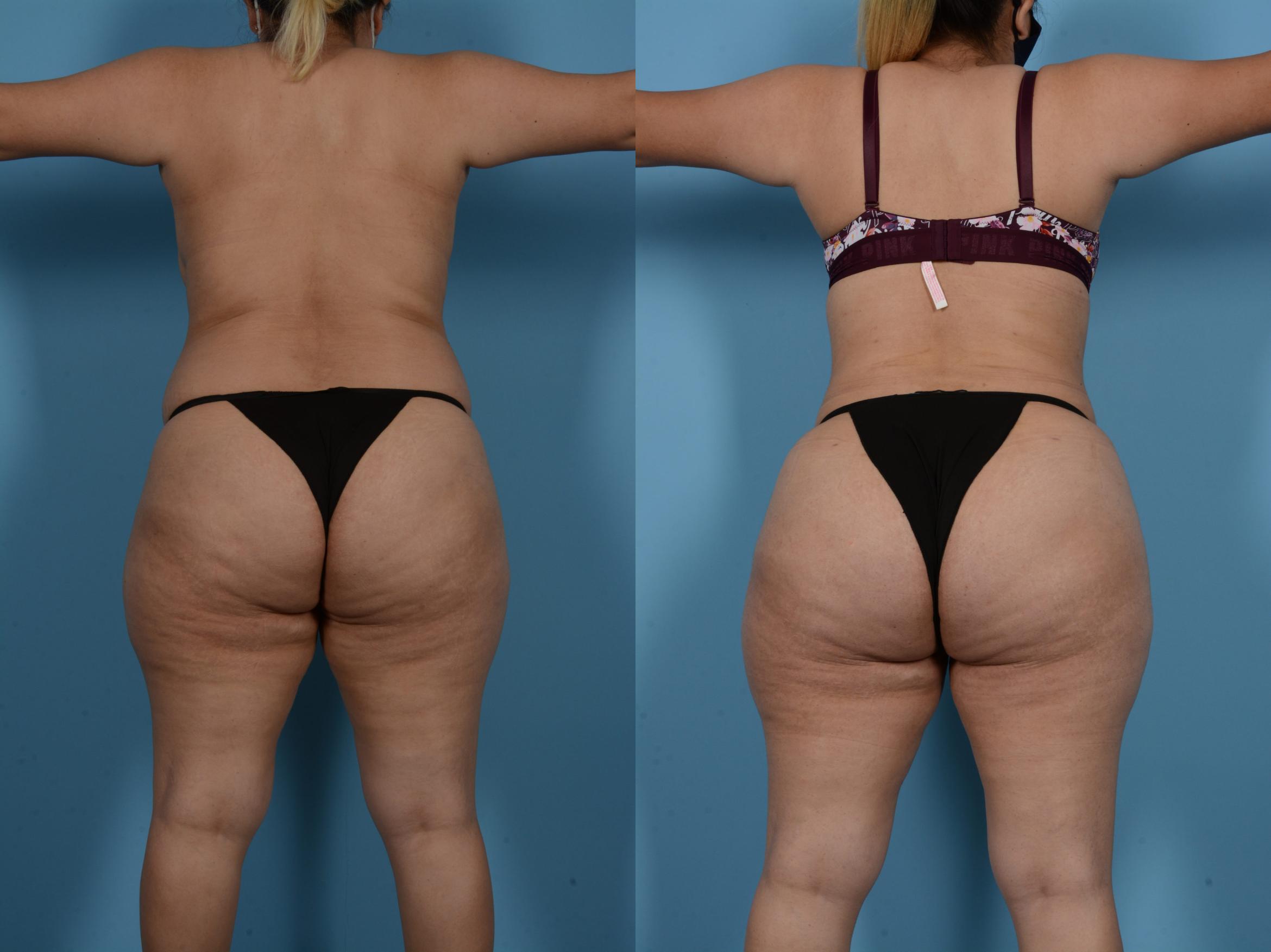 Before & After Tummy Tuck Case 138173 View 4 View in Houston, TX