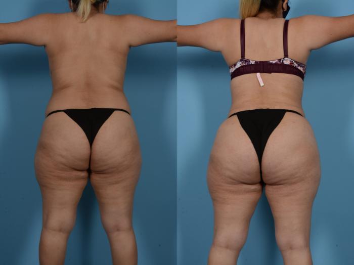 Before & After Tummy Tuck Case 138173 View 4 View in Houston, TX