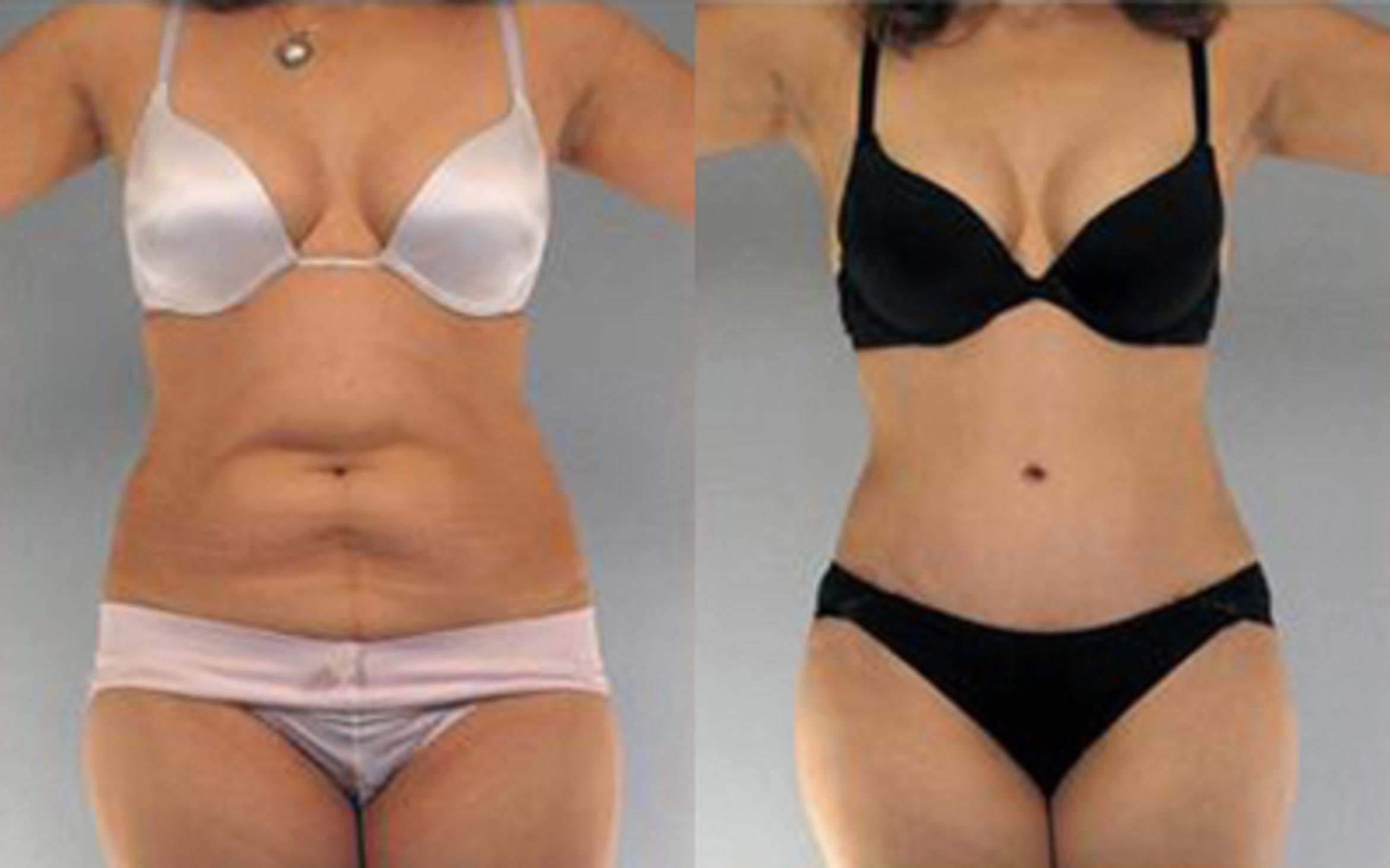 Before & After Tummy Tuck Case 14 View 1 View in Houston, TX