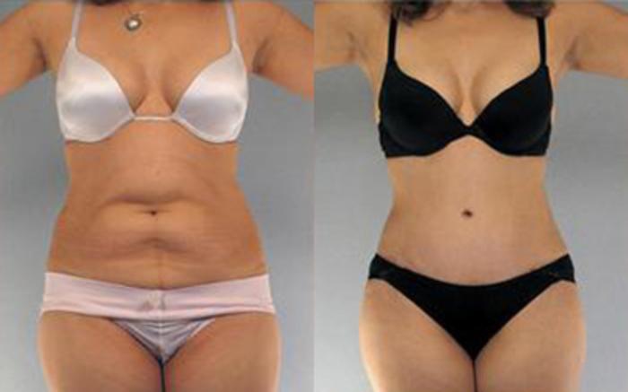 Before & After Tummy Tuck Case 14 View 1 View in Houston, TX